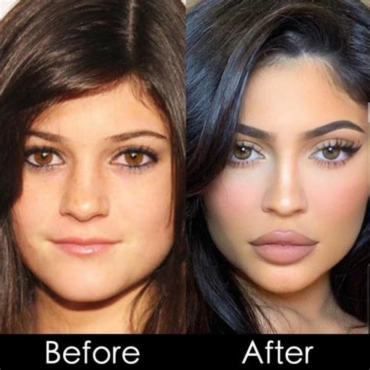 FDA Approves Lip Filler That Lasts A Year — Will Kylie Jenner Do It?